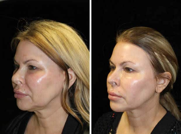 Micro Lifting Treatments Slow Down Aging - Improves Skin