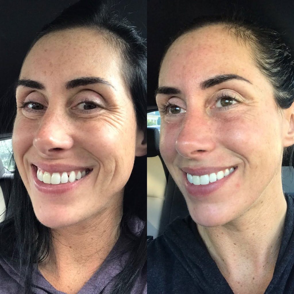 Micro-needling before and after pictures - Boston, MA