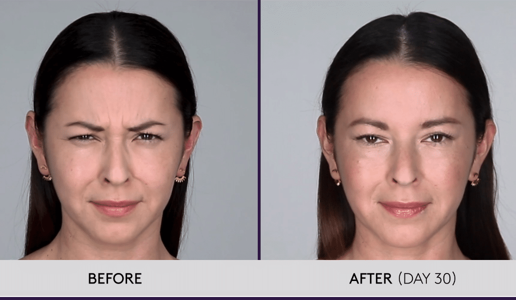 BOTOX® Treatment Near Me HowMuchBotoxwillINeed-44b7a611