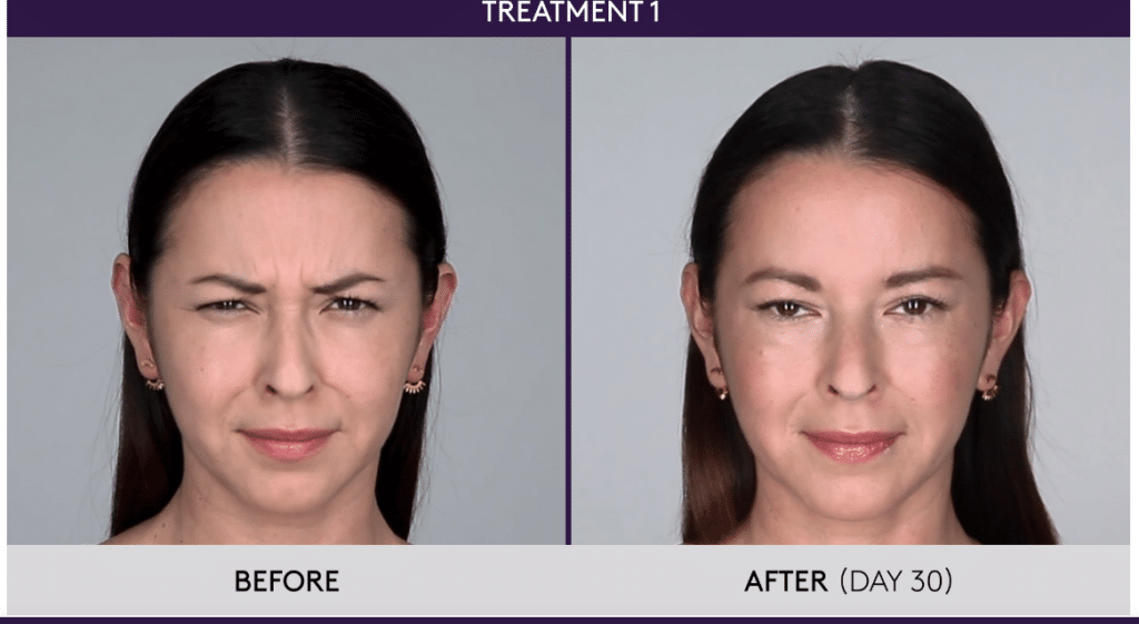 BOTOX® Treatment Near Me HowMuchBotoxwillINeed-44b7a611.jpg-1024x647