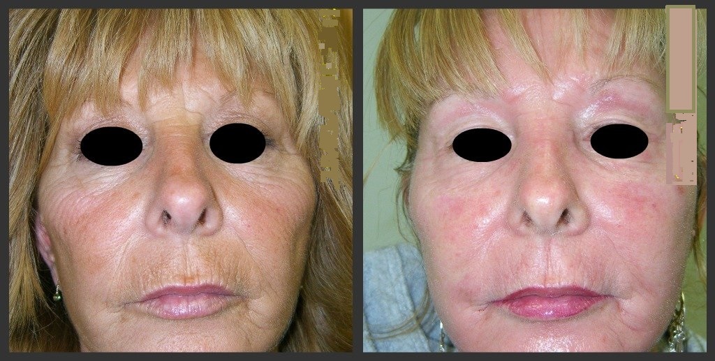 Face Rejuvenation Treatments Agnes-jawline-lift-fat-removal