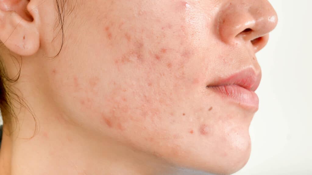 Effective Treatments For Acne Scars: What You Need To Know closeup_acne_scaring-851423236-1024x576