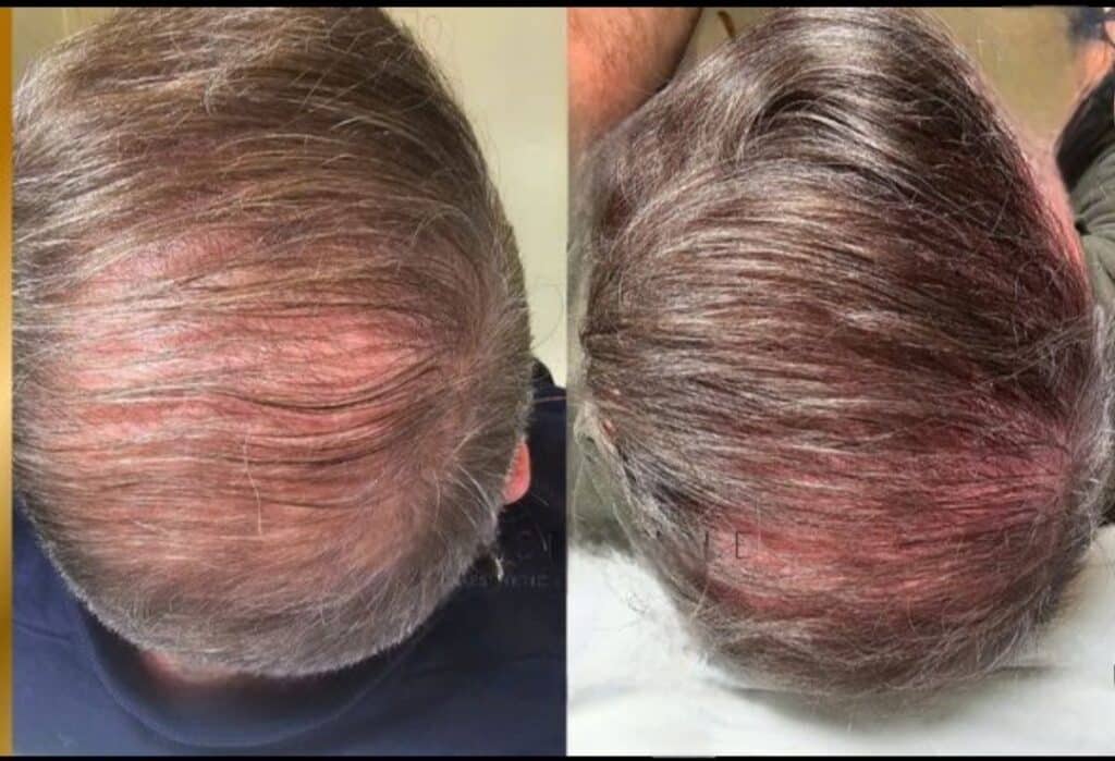 Best Hair Loss Treatment Boston HairRestorationExosomeBoston-1024x699