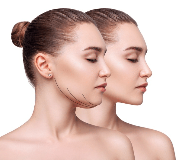 Double Chin Surgery: What to Expect, Cost, Recovery & More image